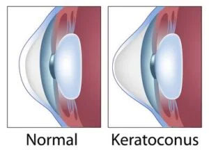 keratoconus afectiune oculara