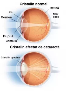 figura explicativa ochi afectat de cataracta