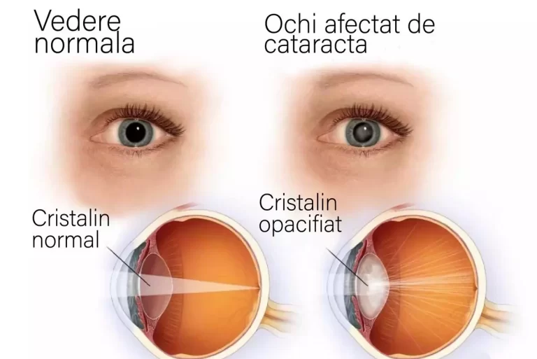 figura comparativa ochi cu cataracta si ochi normal