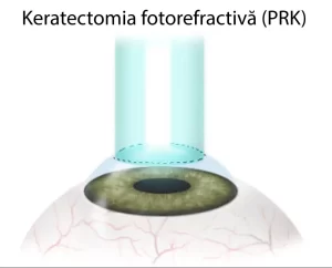 figura reprezentativa operatie PRK sau Keratectomia fotorefractivă