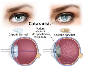 figură comparativa ochi cu cataracta si ochi normal