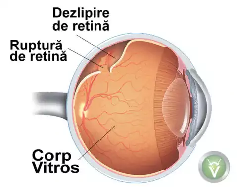 dezlipire de retina