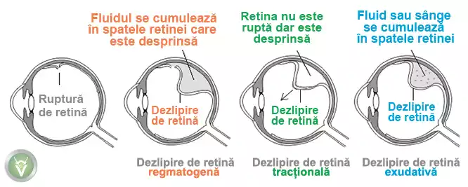dezlipire retina