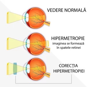 hipermetropia si corectia hipermetropiei cu lentile