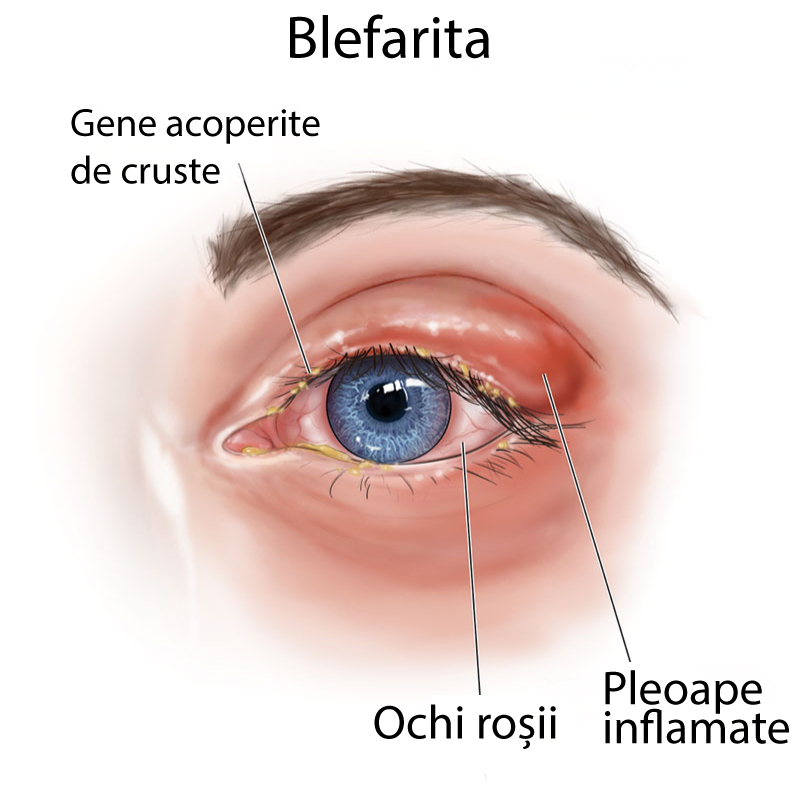 plansa explicativa a ochiului afectat de blefarita